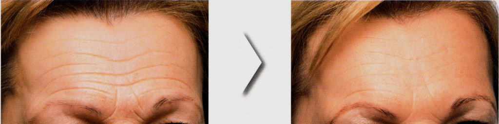 Botox Arrugas frente