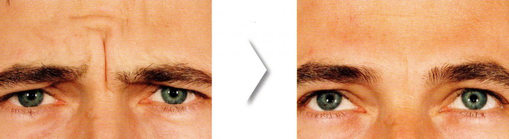 Botox arrugas Entrecejo